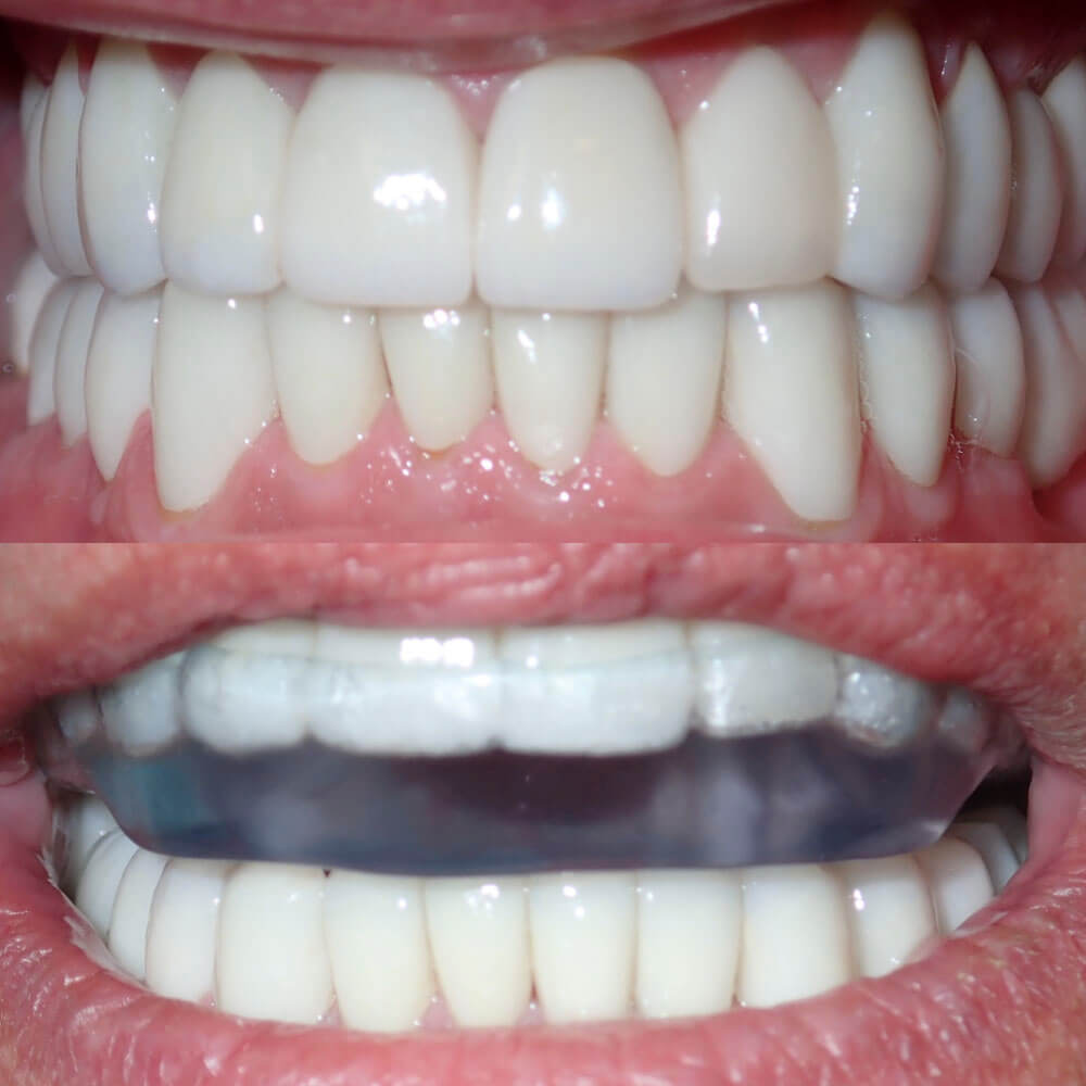 picture of patient's teeth of ESI Dentistry - Esthetic Smiles & Implants after full mouth reconstruction