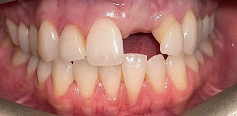 picture of patient's teeth of ESI Dentistry - Esthetic Smiles & Implants before smile makeover
