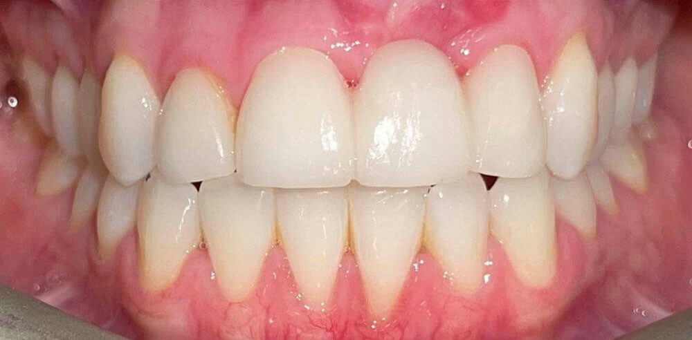 picture of patient's teeth of ESI Dentistry - Esthetic Smiles & Implants after smile makeover