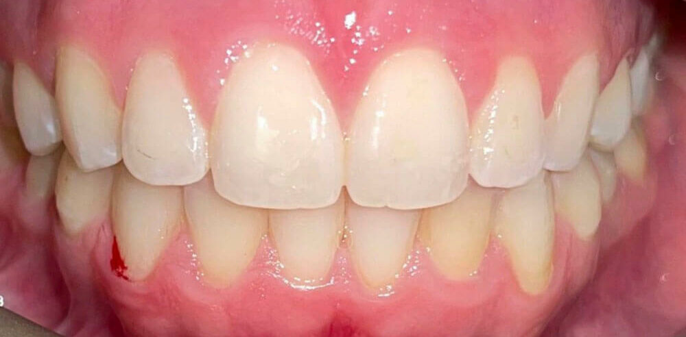 picture of patient's teeth of ESI Dentistry - Esthetic Smiles & Implants after smile makeover