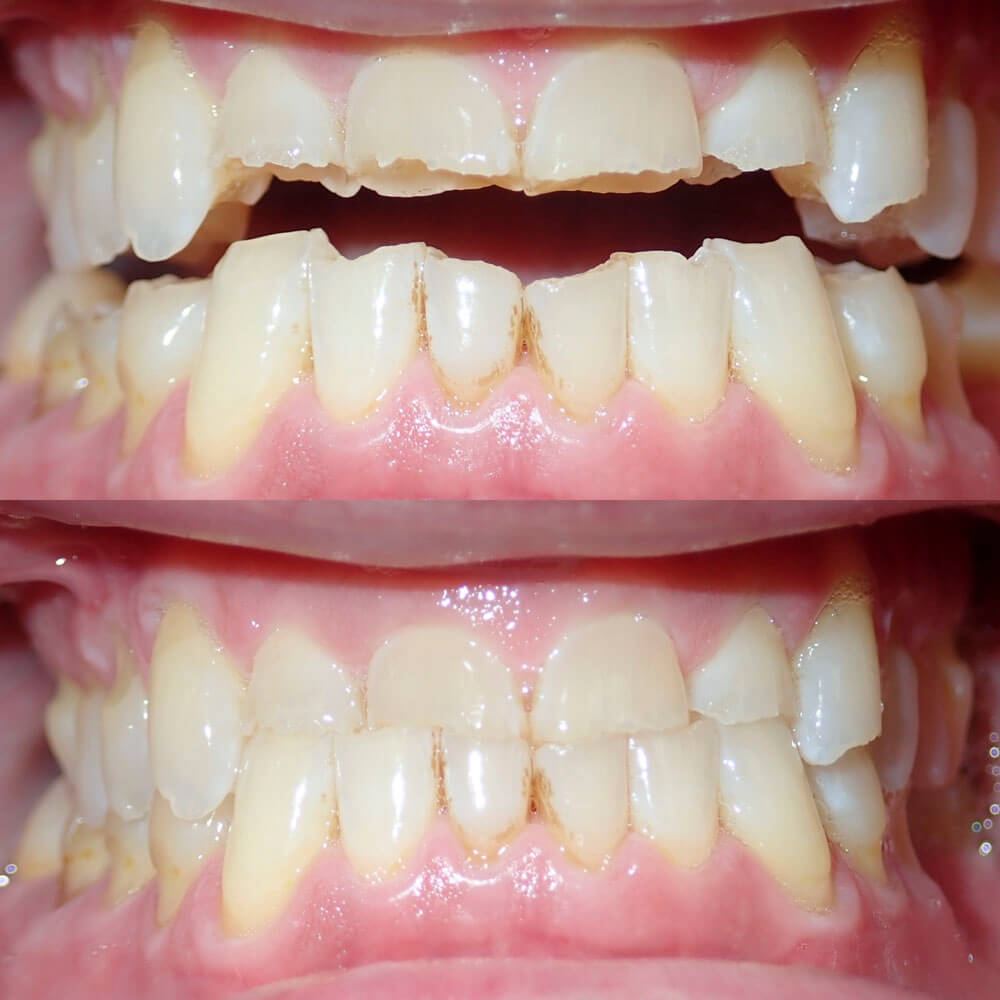 picture of patient's teeth of ESI Dentistry - Esthetic Smiles & Implants before full mouth reconstruction